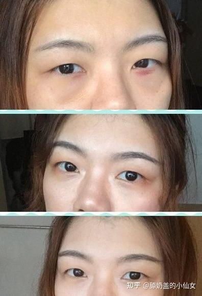 醫(yī)美去眼袋，價格因素與選擇策略，醫(yī)美去眼袋，價格因素詳解與選擇策略指南