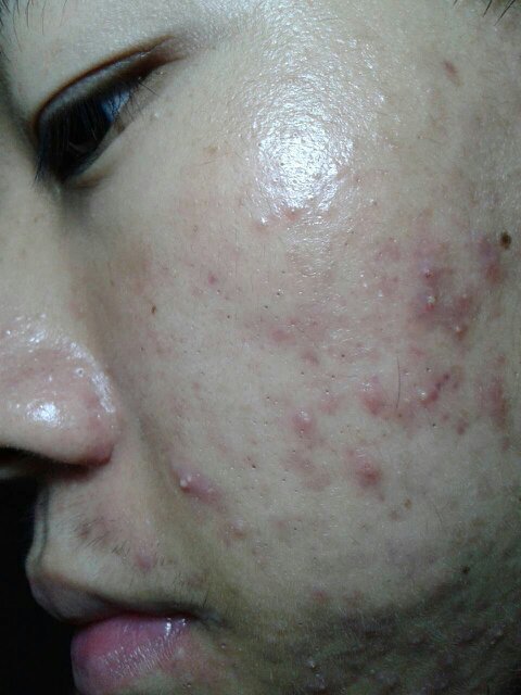 臉上痤瘡圖片，了解、預(yù)防與治療，臉上痤瘡詳解，圖片展示、預(yù)防與治療方法